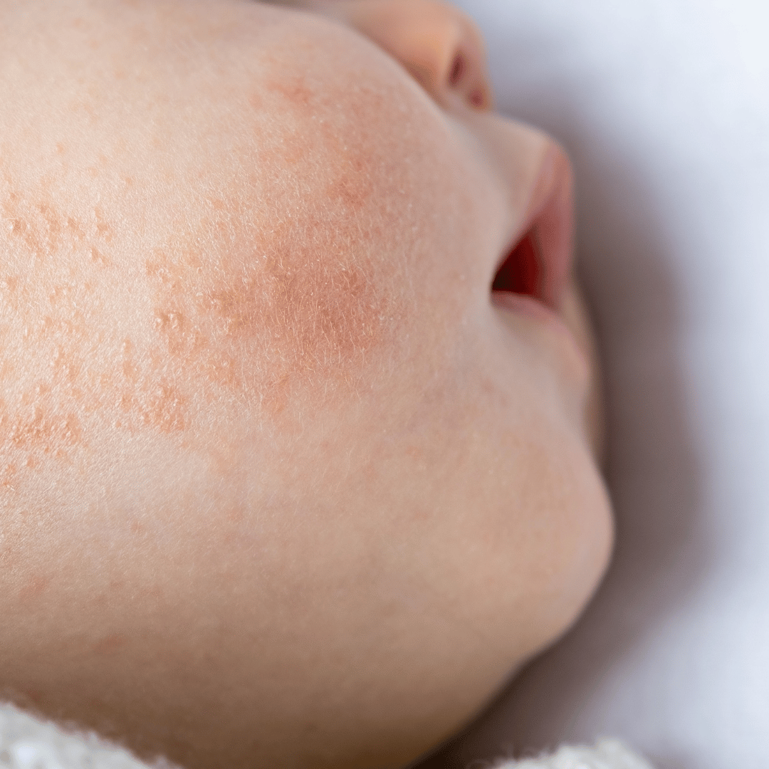 Neurodermitis bei Babys Teil 2: Tipps für den Alltag - KAMI Skincare